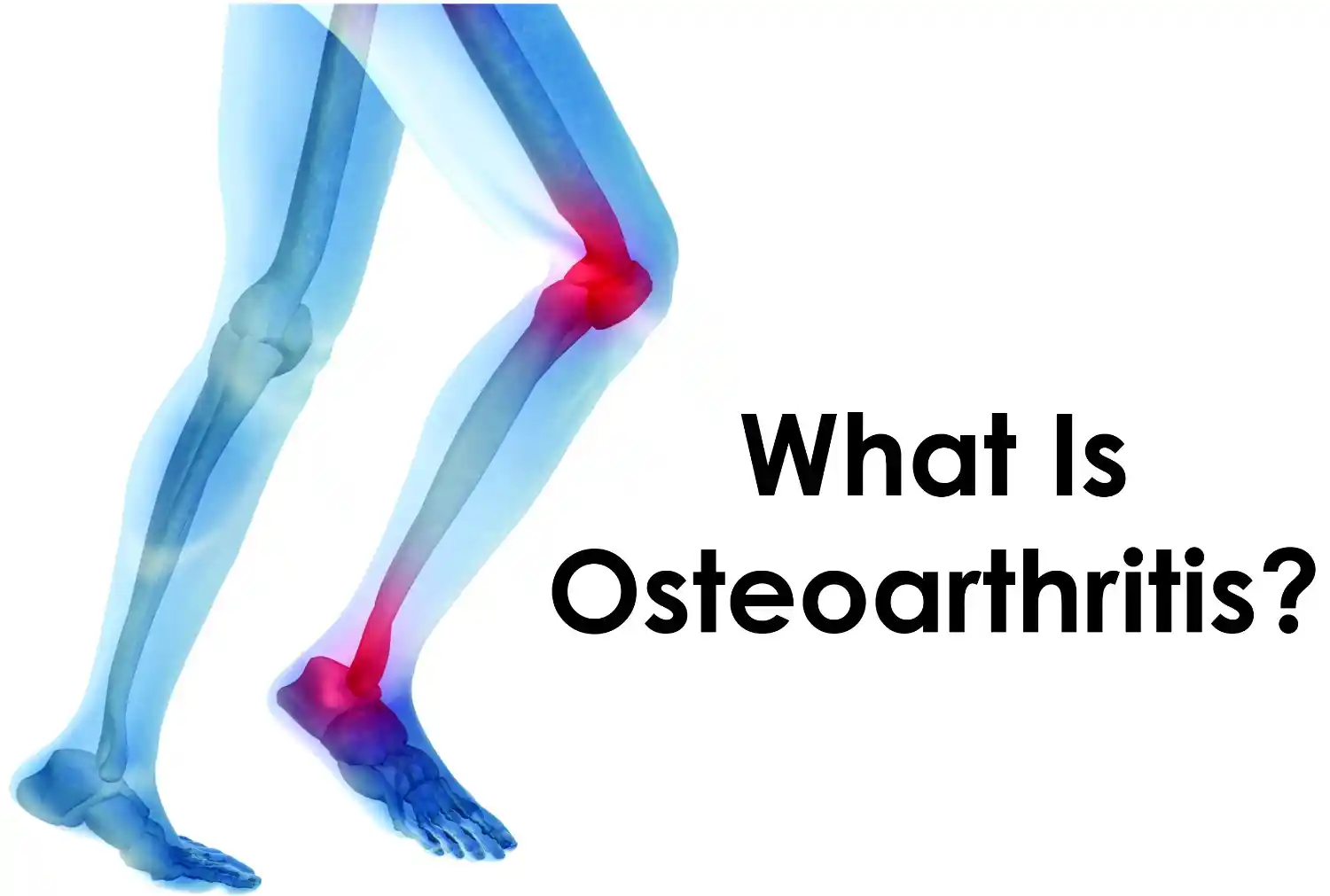 Osteoarthritis