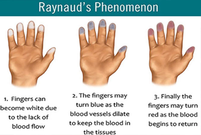 Raynaud’s Phenomenon