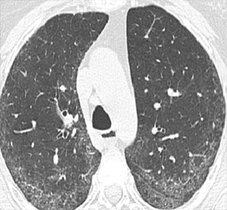 HRCT Thorax