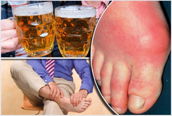 Signs and symptoms of Gout