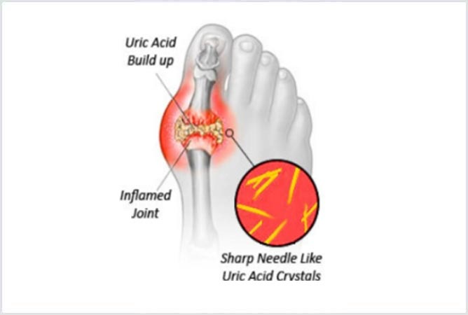 Diagnosis for GOUT