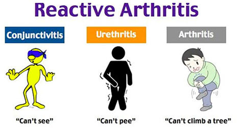 Reactive Arthritis