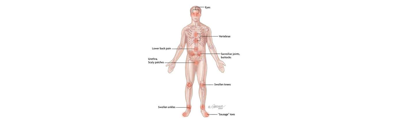 Reactive Arthritis Areas