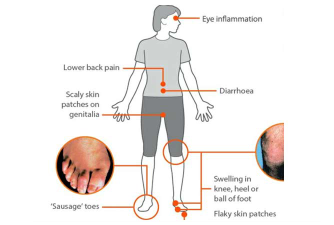 Stiffness & Back Pain