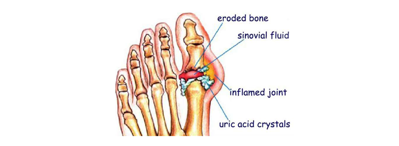 What is GOUT