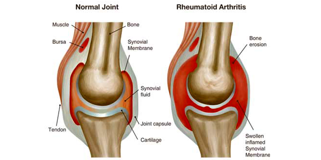 Autoimmune Disease (RA)