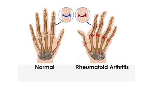 Rheumatoid Arthritis