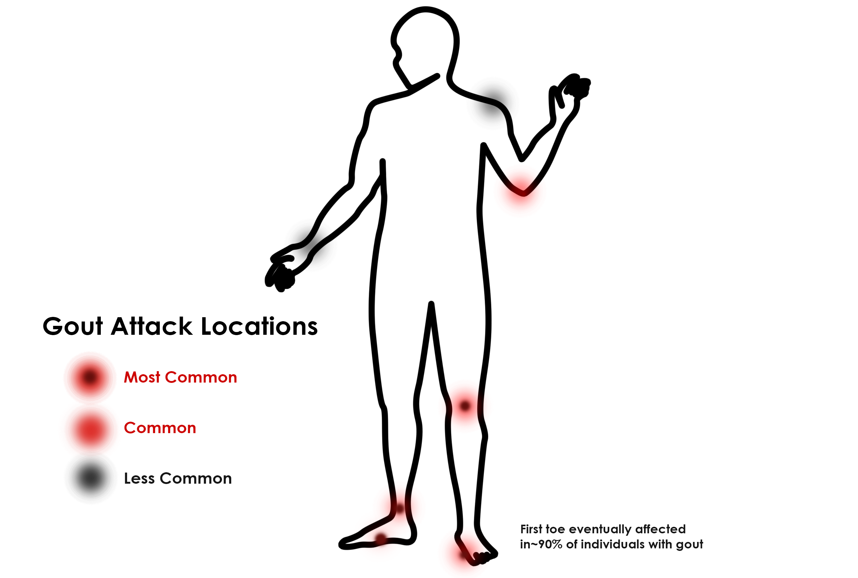 GOUT Attack Locations