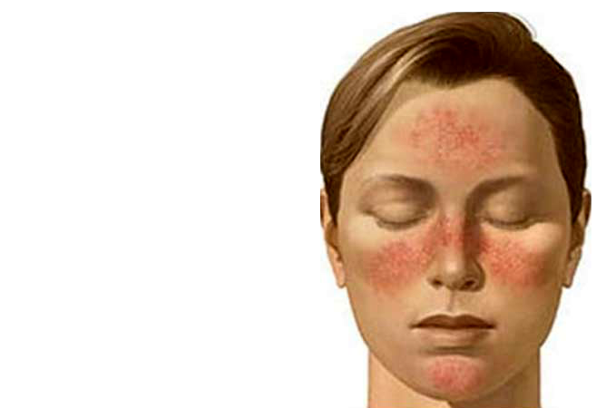 Systemic Lupus Erythematosus