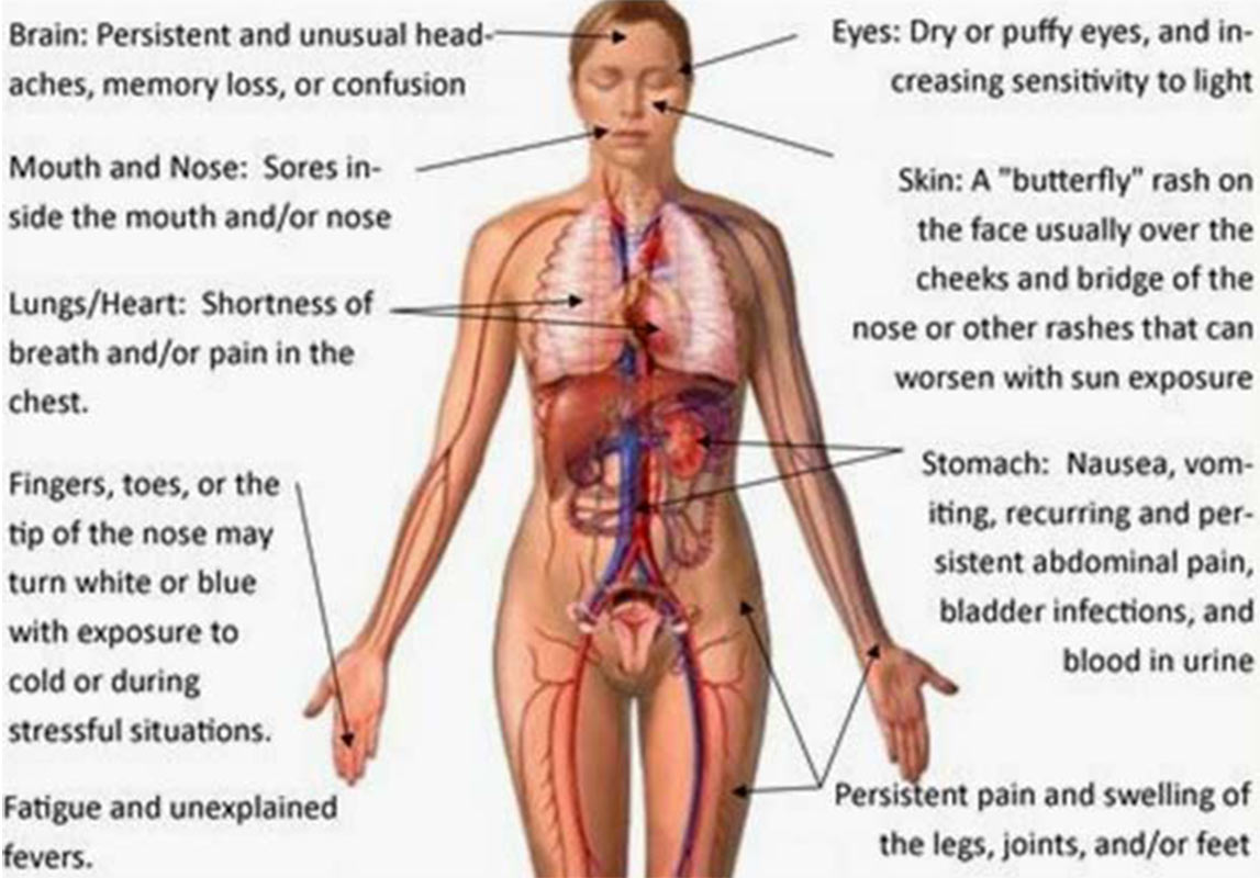 Lupus Sign & Symptoms