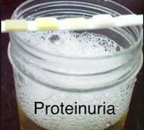 Proteinurea