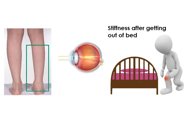 Signs & Symptoms of JIA