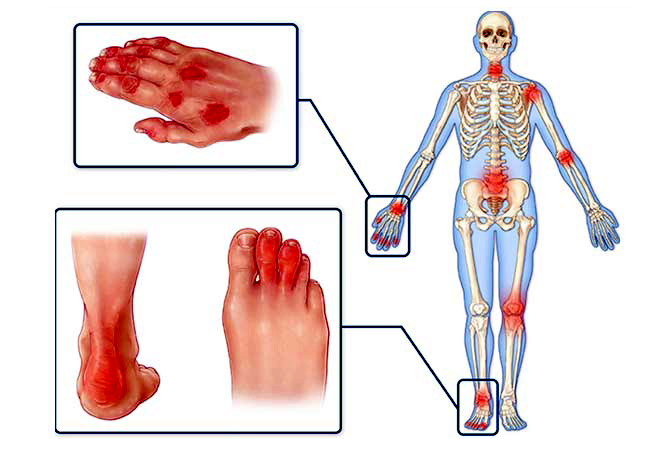 Psoriatic Arthritis