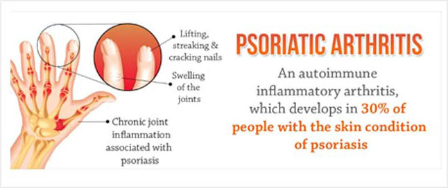 Psoriatic Arthritis