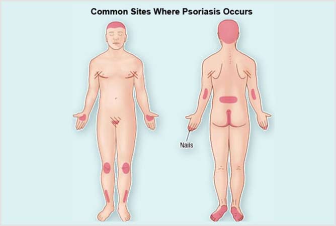 Common sites where Psoriasis occurs