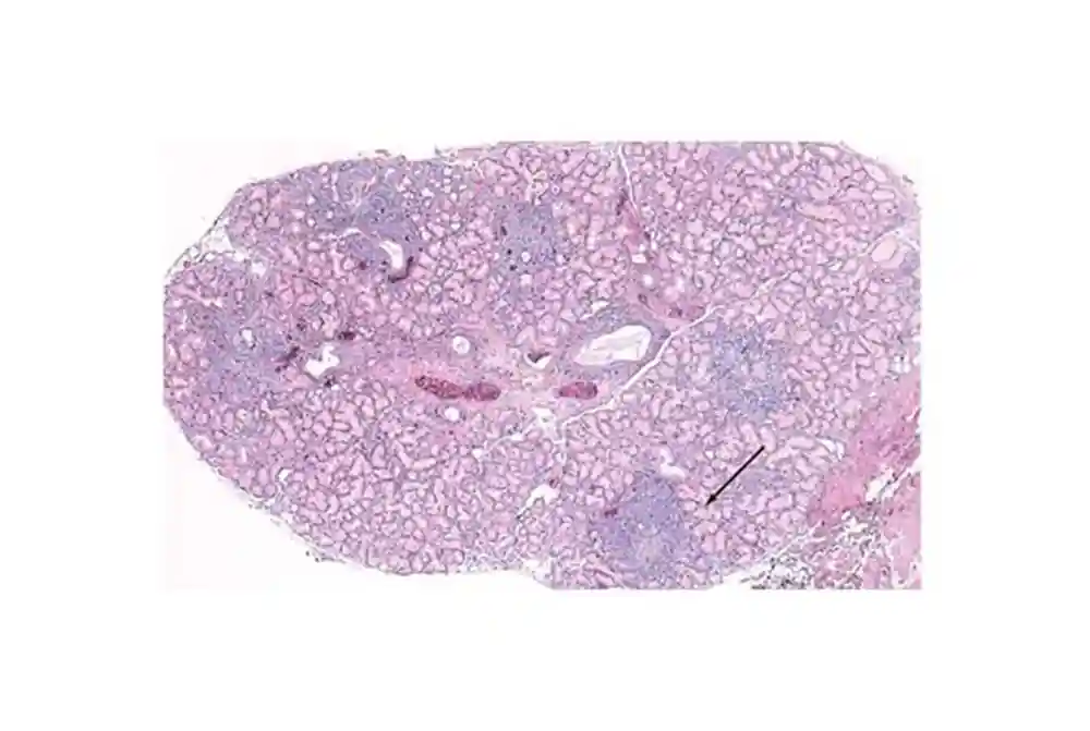 Biopsy of salivary gland