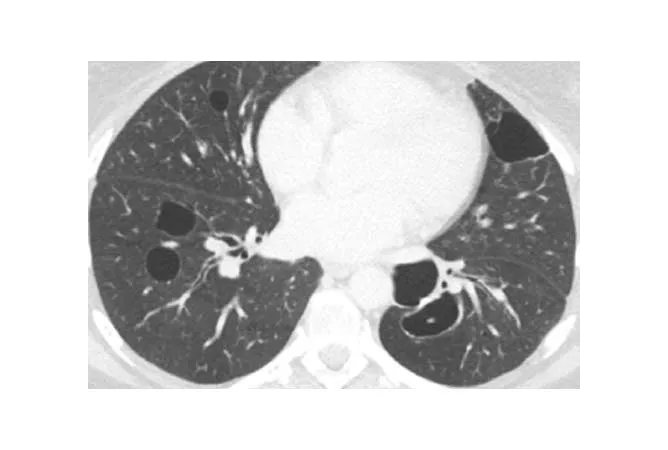 HRCT scan of chest