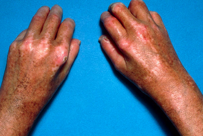 Scleroderma