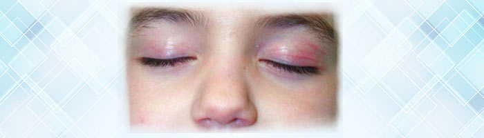 dermatomyositis in eyes