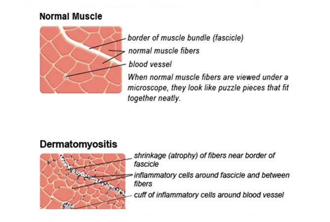 Muscle Biopsy