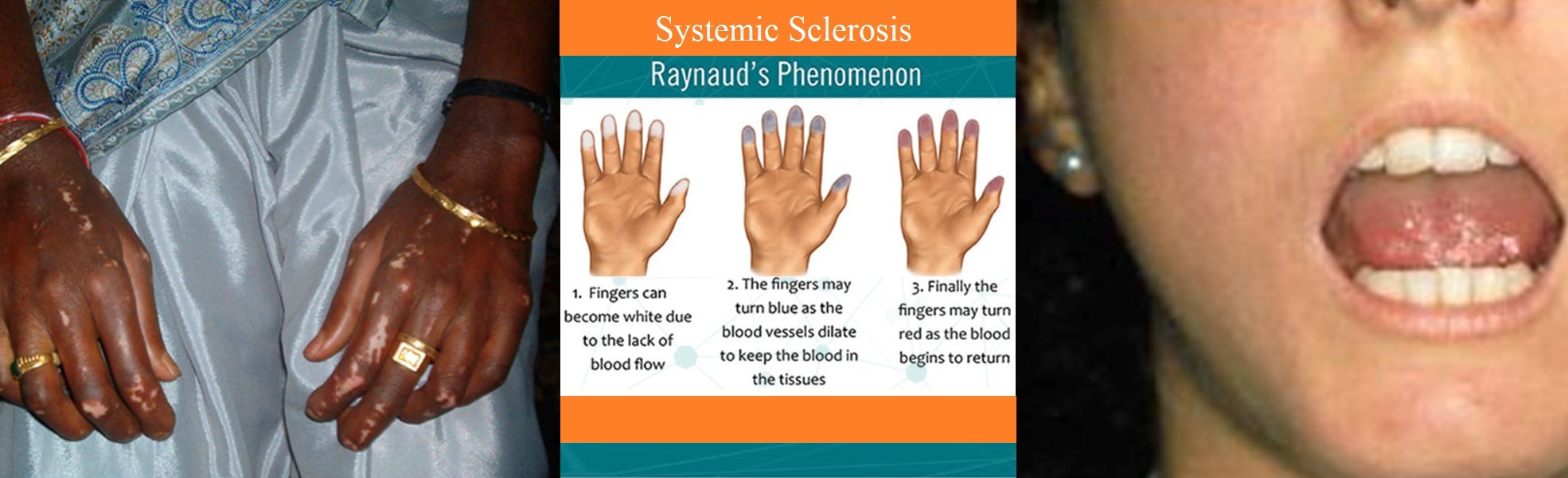 systemic sclerosis