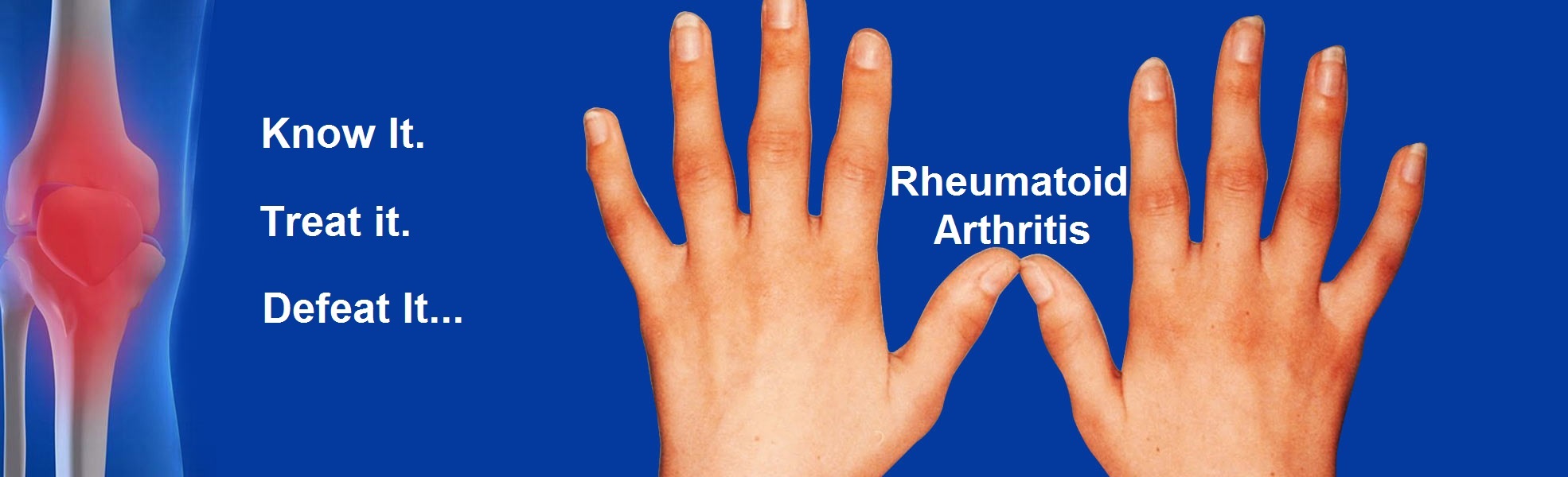 rheumatoid arthritis