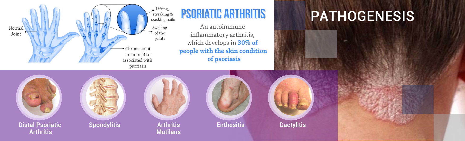 psoriatic arthritis