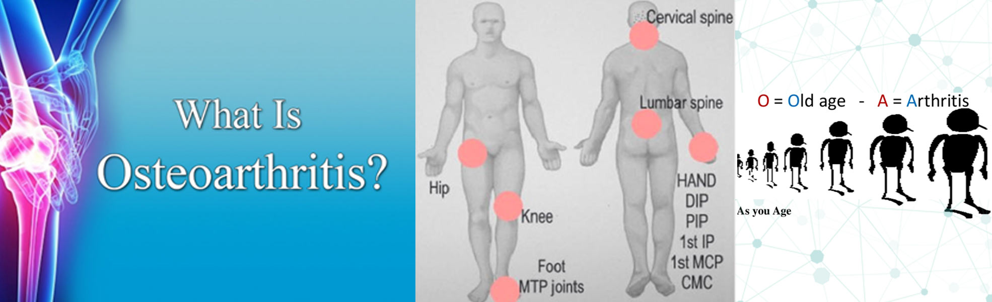 osteoarthritis