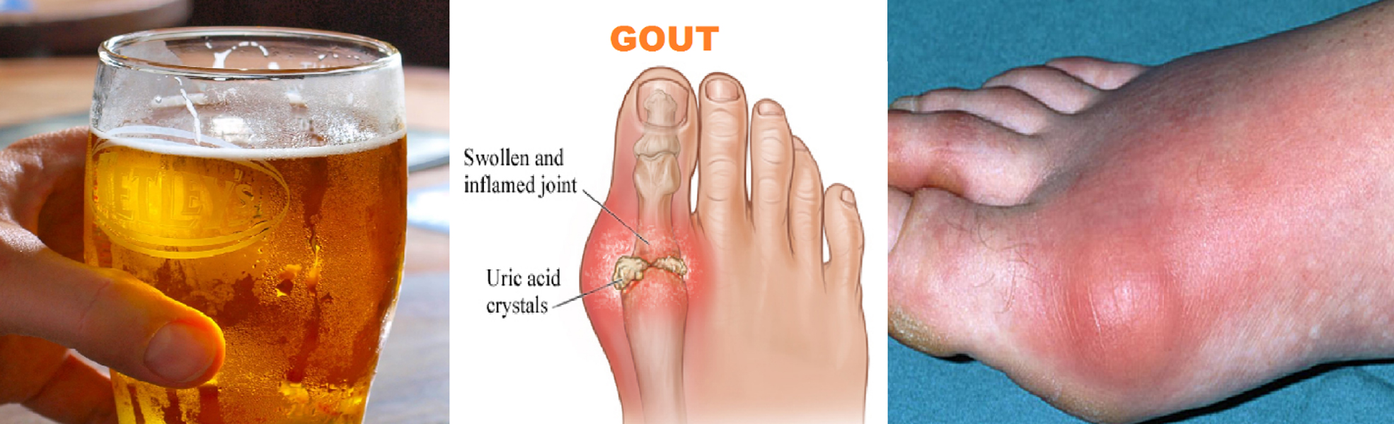 gout