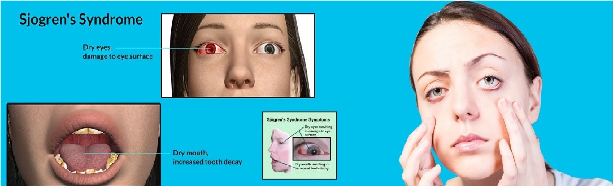 sjogrens syndrome